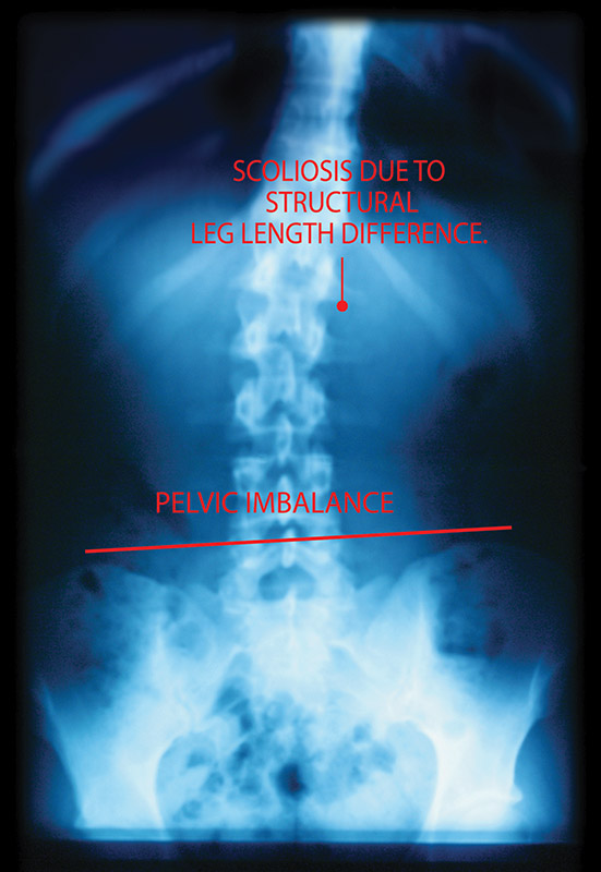 lower back and hip pain