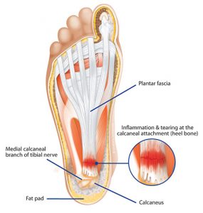 Plantar Fasciitis